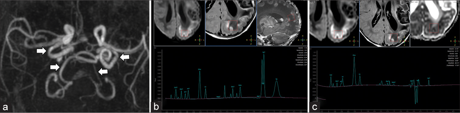Neonate with incessant seizures (a) 3D reformatted image of the magnetic resonance (MR) angiogram of intracranial vessels shows tortuosity of the intracranial vertebral and internal carotid arteries (white arrows). (b) MR spectroscopy (MRS) with region of interest in the left parietal lobe at short TE (35 ms) McRS shows reduced N-acetylaspartate (NAA) peak at 2.0 ppm and a large lactate doublet at 1.3 ppm. (c) The lactate doublet inverts on intermediate TE (144 ms) MRS.