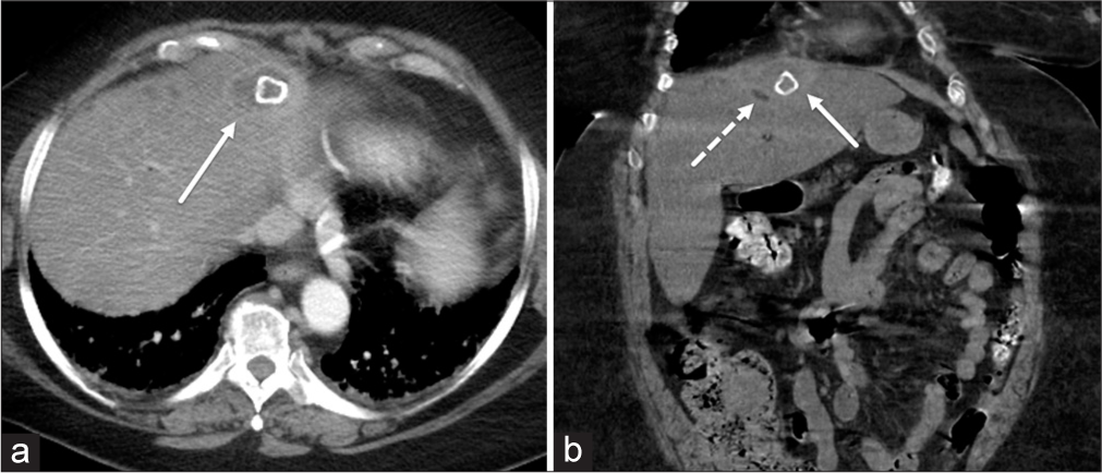 (a) Contrast-enhanced computed tomography (CT) of the upper abdomen shows a new fluid collection in the subdiaphragmatic space (solid arrow) with an internal rectangular peripherally calcified focus reminiscent of a gallstone. (b) Follow-up non-contrast CT again shows the subdiaphragmatic fluid collection (solid arrow), now with adjacent area of hypodensity (dashed arrow) that is suspicious for infectious changes.