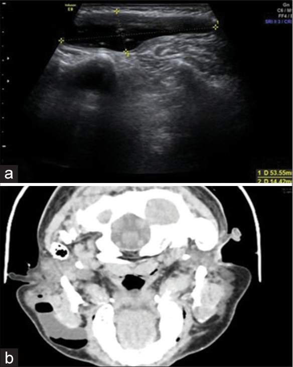 (a) Ultrasonography image in axial plane with a linear transducer over the right cheek region; shows the size of the swelling of around 5×1.5 cm; (b) contrast-enhanced axial image of the face and neck depicts a large cystic swelling in the right parotid region; with air-fluid levels; along the direction of the right parotid gland.