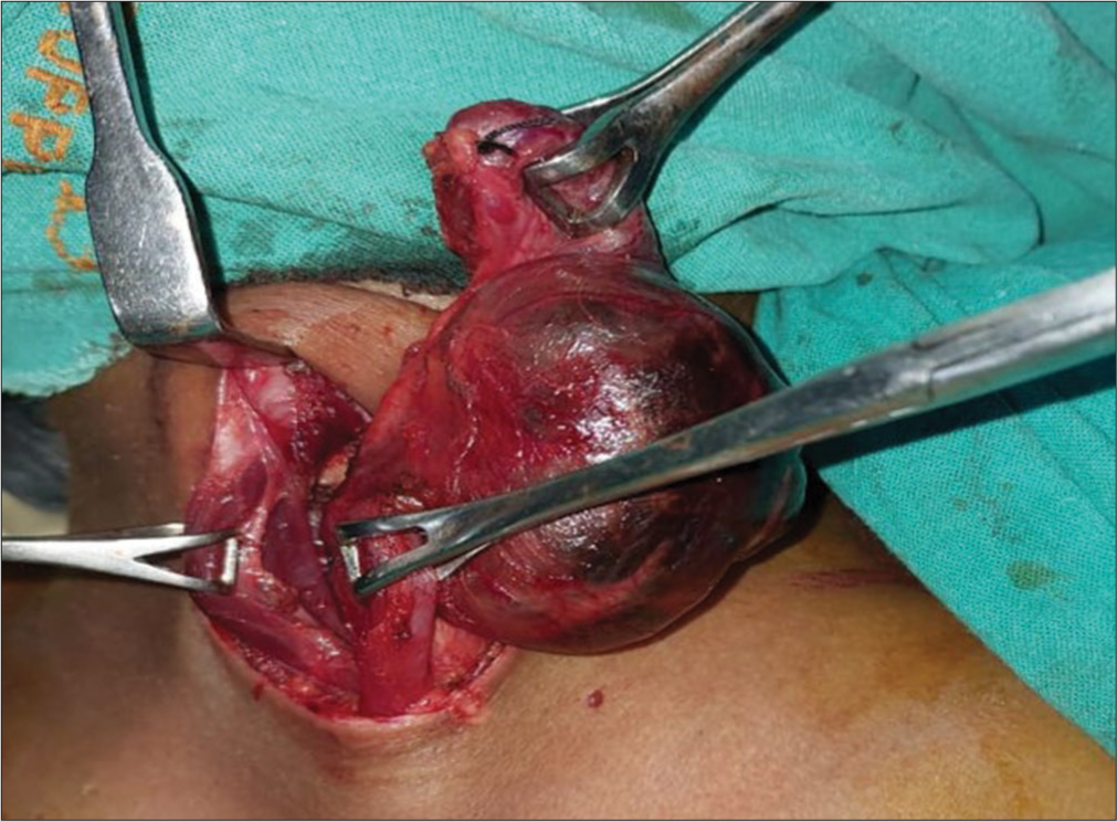 Intraoperative zoomed image depicts the photography of removal of the parotid duct sialocele.