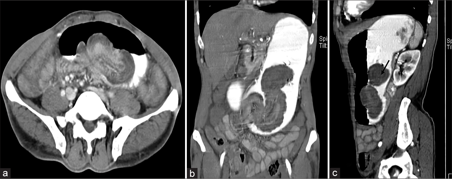 Contrast-enhanced computed tomography (a) axial and (b) coronal sections show intraluminal projection of jejunal bowel loops along with mesenteric vessels into stomach and (c) sagittal section shows Target sign (black arrow) consistent with intussusception.