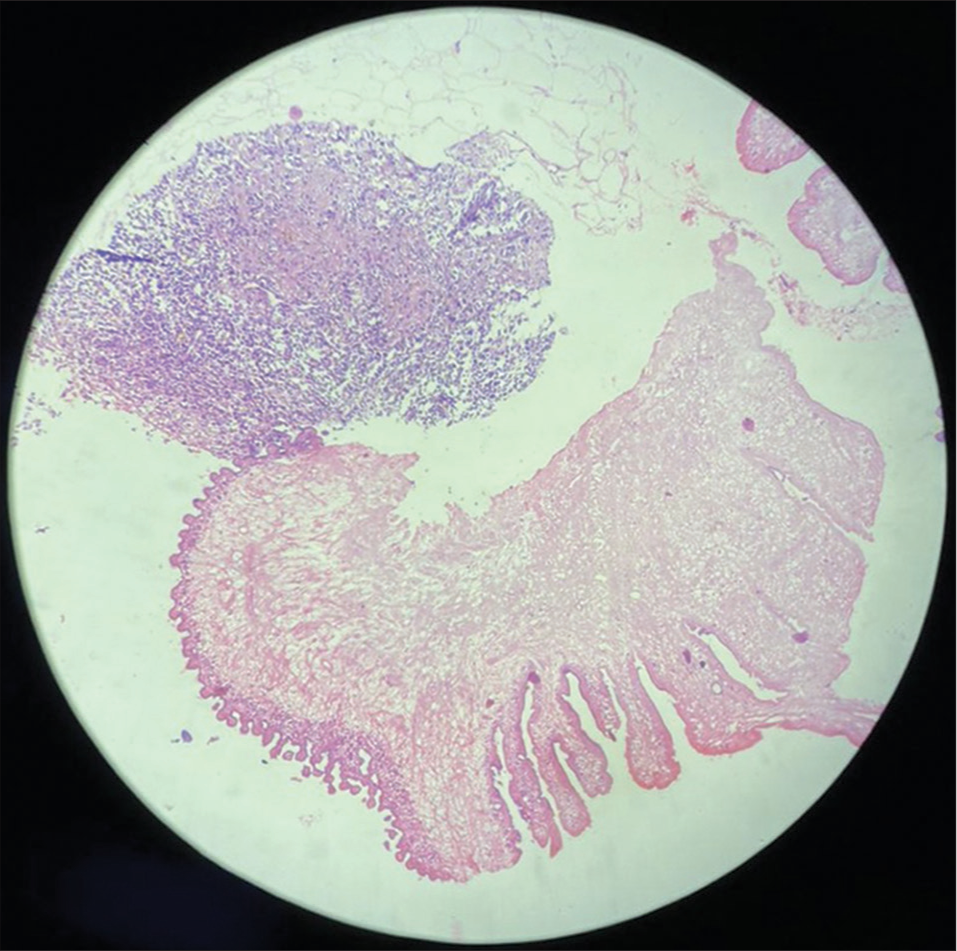 A 62-year-old woman with breast cysticercosis presented with a painful breast mass. Histopathological image revealing a parasite with irregularly shaped membranous folding and an adjacent area showing a granulomatous reaction.