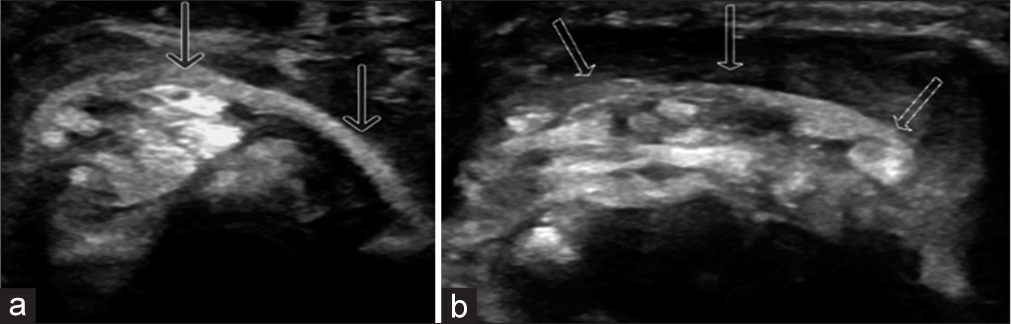 Ultrasonography (USG) appearance of rubber band at the level of the proximal crease of the wrist joint. Transverse USG of the volar aspect of the wrist joint (a) shows circumferential linear echogenic foreign body (arrows) deep to the flexor retinaculum between the flexor digitorum profundus and digitorum superficialis tendons, which represents the rubber band. Transverse USG of the dorsal aspect of the wrist joint (b) shows circumferential linear echogenic foreign body (arrows) deep to the extensor retinaculum and superficial to extensor tendons, which also represents rubber band.