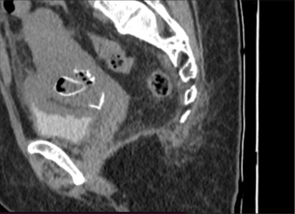 Computed tomography showing calcified structures (foetal bones).