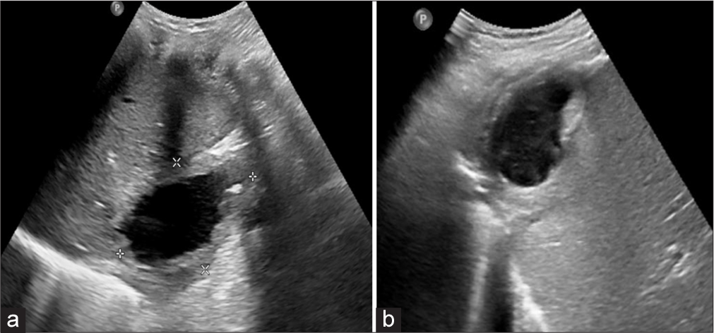 (a) Ultrasound image showing irregular thick wall collection with small hyperechoic focus in the wall seen in subcapsular location of segment VII of liver. (b) Ultrasound image showing Irregular thick wall collection with echogenic content in subcapsular location of segment VII of liver.