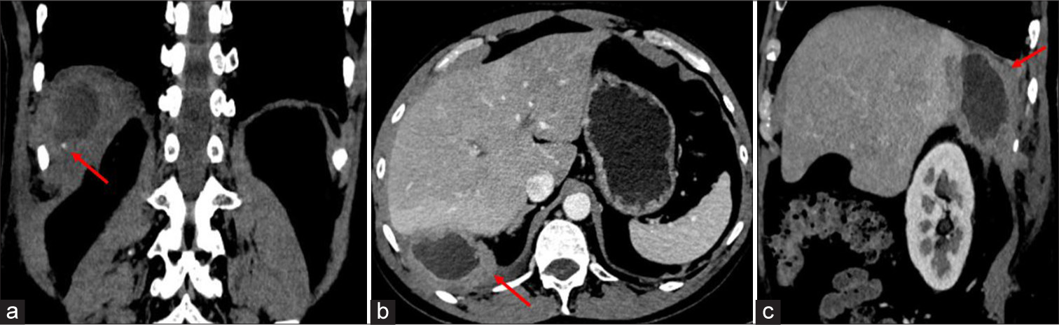 (a) Computed tomography of abdomen plain (coronal view) showing an ill defined hypodense collection in right subdiaphragmatic region with thick wall and small calcific foci in the wall, (red arrow) indicates small calcific foci. (b) Contrast enhanced computed tomography of abdomen axial section showing central non enhancing hypodense collection with thick irregular peripherally enhancing wall. Red arrow indicating abscess in right subdiaphragmatic region. (c) Contrast enhanced computed tomography of abdomen axial section showing central non enhancing hypodense collection with thick irregular peripherally enhancing wall. Red arrow indicating abscess in right subdiaphragmatic region.