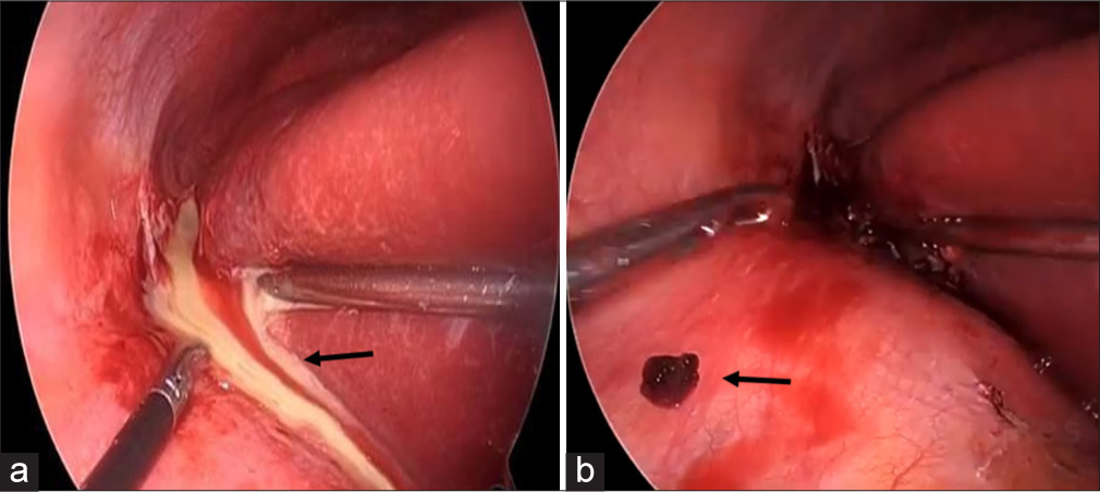 (a) Laparoscopic images showing drainage of abscess. Black arrow indicating Pus. (b) Laparoscopic image showing retrieved gallstones. Black arrow indicating stone.