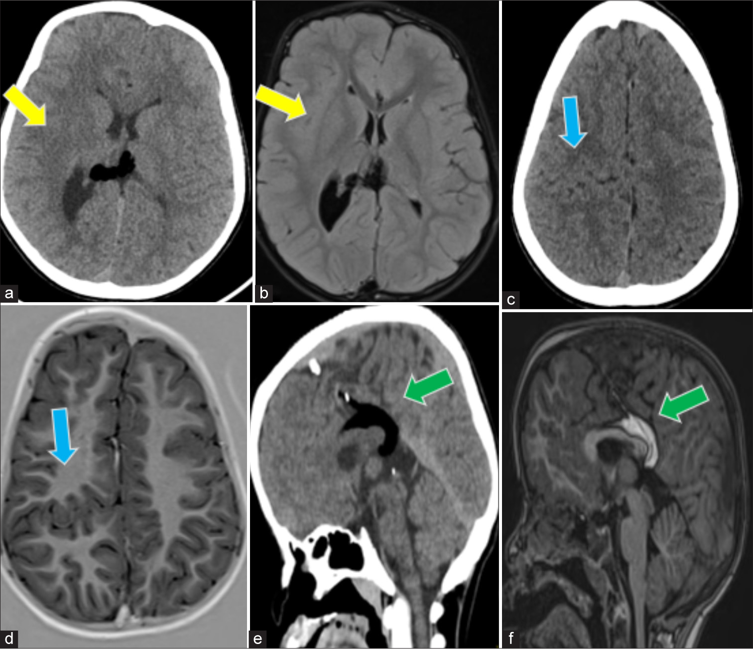 (a and b) Computed tomography (CT) brain axial and MRI brain FLAIR axial sections shows large right cerebral hemisphere with prominent lateral ventricle – s/o hemimegalencephaly (yellow arrows). (c and d) CT brain axial and magnetic resonance imaging (MRI) brain T1w axial sections shows a gray matter lined cleft in the right parietal lobe with closely approximated cleft walls – s/o closed lip schizencephaly (blue arrows). (e and f) CT brain coronal and MRI brain T1w coronal sections show mild corpus callosum hypoplasia with T1 hyperintense/CT fat dense lesion in pericallosal region – s/o pericallosal lipoma (green arrows). FLAIR: Fluid attenuated inversion recovery. s/o: Suggestive of.