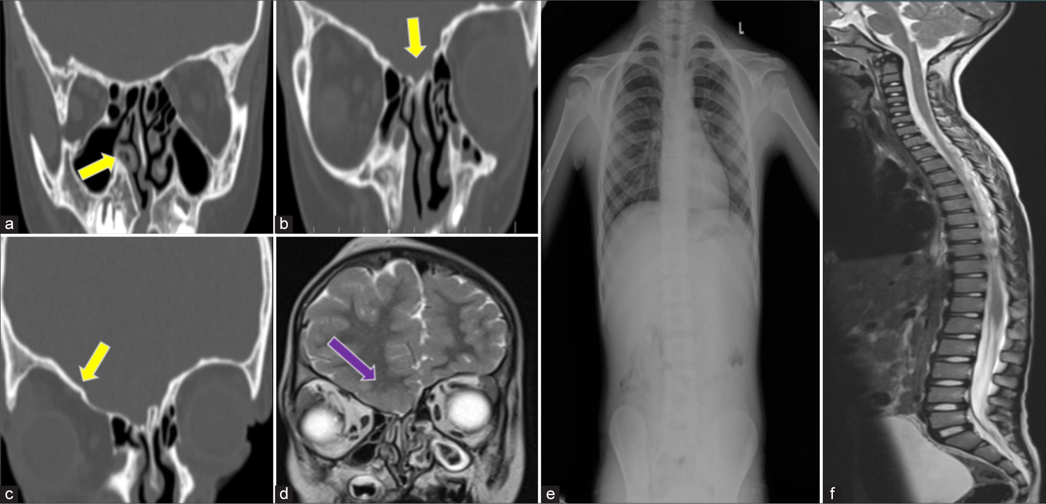 Computed tomography brain coronal bone window (a-c) shows hypoplastic right middle and inferior turbinate’s, hypoplastic ethmoid bone and cribriform plate of ethmoid and asymmetry of right orbit (yellow arrows). Magnetic resonance imaging (MRI) brain T2-weighted (T2W) coronal section (d) shows absent bilateral olfactory bulbs (purple arrow). (e) X-ray dorsolumbar spine – PA view and (f) MRI T2W whole spine shows no vertebral abnormalities. PA: Posteroanterior, L: Left side.