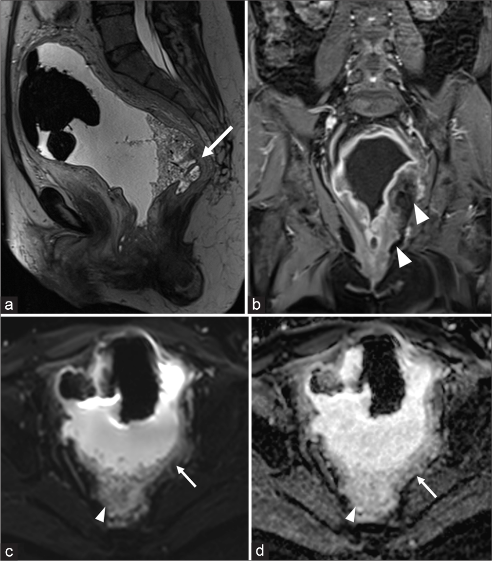 Magnetic resonance imaging (a) sagittal T2WI image of the pelvis demonstrates the large diverticular cavity communicating with the rectum (white arrow). (b) Coronal contrast enhanced T1WI shows enhancing wall and mucosa with intense peri-diverticular inflammation (white arrowheads). (c and d) Diffusion-weighted image with b value-1000 and apparent diffusion coefficient show no restriction in and around the diverticulum (white arrows). The white arrowheads point to fecal material within the diverticulum.