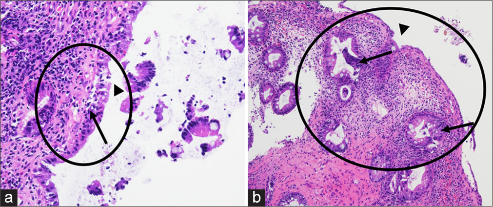 On histology with hematoxylin and eosin staining at (a) 200x and (b) 100x magnification, the colorectal mucosa shows ulceration (black arrowheads) and granulation tissue (oval demarcated area) due to reactive changes including hyperplastic changes and crypt distortion (black arrows). Abundant acute inflammation is present in the form of scattered neutrophils throughout the specimen.