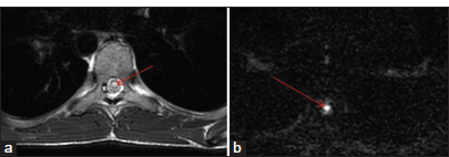 (a) Axial T2W showing hyperintense signal (red arrow) in central grey matter of dorsal cord. (b) Corresponding DWI image showing restriction hyperintense signal marked by red arrow. DWI: Diffusion-weighted imaging.