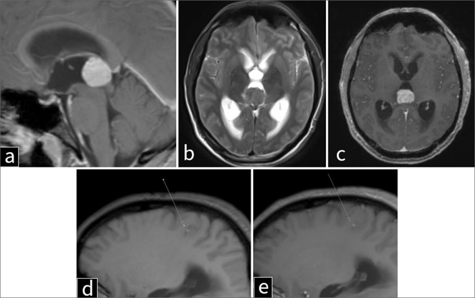 Magnetic resonance imaging of the brain in a 41-year-old man with metastatic melanoma to the pineal gland. (a) T1-weighted sagittal, (b) T2-weighted axial, (c) post-contrast T1-weighted axial, (d) T1-weighted parasagittal, and (e) post-contrast T1-weighted parasagittal views of the brain demonstrate a well-circumscribed, T1-hyperintense pineal lesion resulting in severe mass effect on the tectum and cerebral aqueduct, with associated obstructive hydrocephalus of the lateral and third ventricles and transependymal cerebrospinal fluid flow. The mass appears to originate from the anterior aspect of the pineal region and measures 2.1 × 2.1 cm. Another focus of leptomeningeal T1 hyperintensity is noted in the posterior right parietal lobe (arrows in d and e).