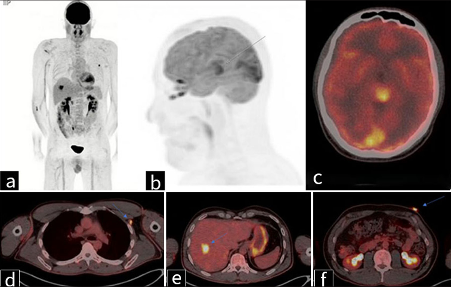 Positron emission tomography imaging in a 41-year-old man with metastatic melanoma. (a) Coronal and (b) sagittal maximum intensity projection images, along with (c-f) transaxial fused images, demonstrate (c) a hypermetabolic pineal mass measuring slightly >2 cm, with a maximum standardized uptake value (SUV) of 17.6 (gray arrow in b). (d) A 1.0 cm markedly fluorodeoxyglucose-avid left retropectoral lymph node is noted, with a maximum SUV of 7.3 (blue arrow). (e) A liver lesion in segment 7/8 measures approximately 3 cm and has a maximum SUV of 9.6 (blue arrow). (f) A skin lesion in the left upper abdomen measures approximately 17 mm, with a maximum SUV of 8.4 – primary source of malignant melanoma (blue arrow).
