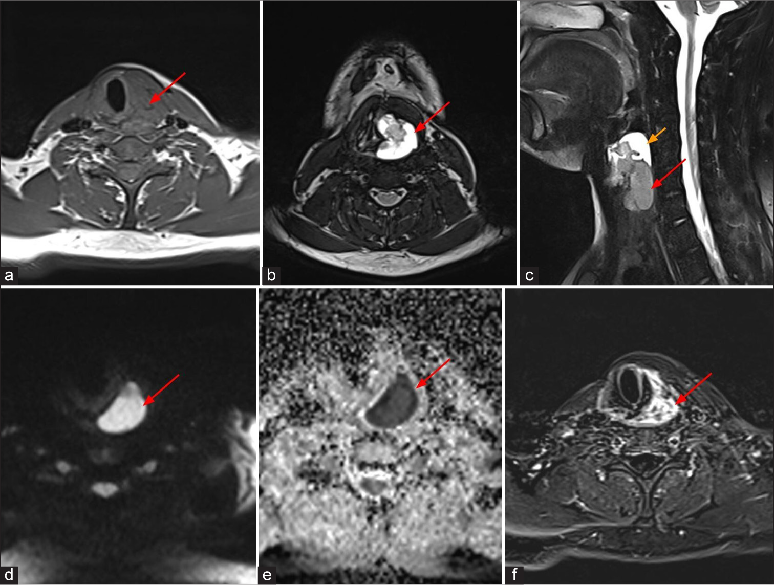 A 20-year-old male who presented with hoarseness of voice and dysphagia, MRI shows well-defined lobulated solid cystic lesion in hypopharynx just behind the left pyriform fossa, which appears isointense to skeletal muscle (red arrow) on (a) axial T1 weighted image, hyperintense (red arrows) on (b) axial and (c) sagittal T2 weighted images. (c) Sagittal T2 weighted image shows T2 hyperintense cystic component (yellow arrow) on superior aspect of the lesion. The solid component shows restricted diffusion (red arrows) on (d) diffusion weighted sequence and (e) apparent diffusion coefficient and (f) heterogeneous enhancement (red arrow) on post contrast subtracted image.