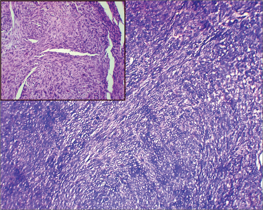 Low-power and high-power (Inset image) histopathology image shows spindle cells arranged in fascicles. Stain: Hematoxylin and eosin.