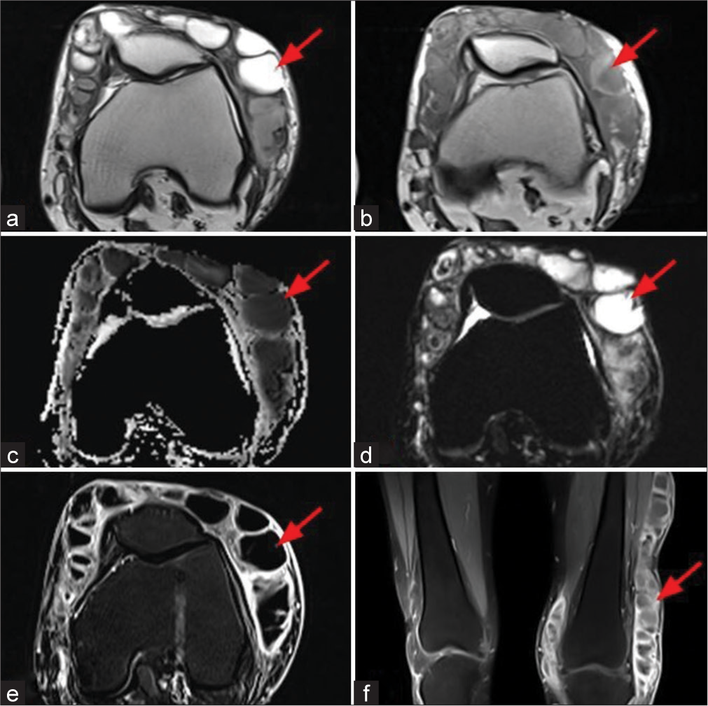 A 41-year-old male with complaints of the left knee swelling with multiple draining sinuses and nodules for the past 6 months, (a and b) T2-weighted axial and T1-weighted axial MR images show an extensive T2 hyperintense/hypointense and T1 hypointense multiloculated collections in subcutaneous plane of lower thigh and knee regions (red arrows), (c and d) Apparent diffusion coefficient and diffusion-weighted image shows significant diffusion restriction (red arrows) (e and f) subtracted and post contrast T1 fat-saturated images show smooth thin peripheral enhancement (red arrows).