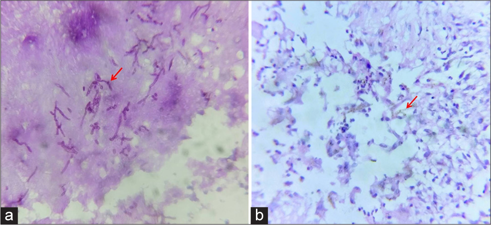 Histopathology image (a) periodic acid Schiff stain shows thin septate fungal hyphae (red arrow) and (b) high-power view shows brown pigmented thin septate fungal hyphae (red arrow).