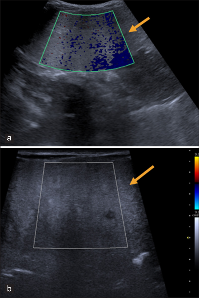 A 1 year old boy with omental lipoblastoma. Ultrasound abdomen with (a) low frequency and (b) high frequency examination shows a large, predominantly hyperechoic solid lesion (orange arrows) occupying the entire abdominal cavity. (a) The bowel loops are seen displaced posterior to the mass.