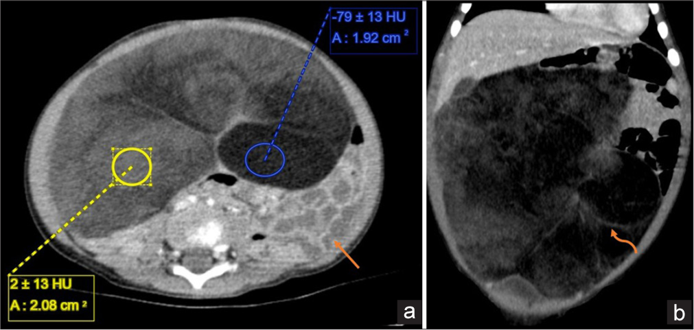A 1-year-old boy with omental lipoblastoma, Contrast enhanced CT abdomen (a) axial and (b) coronal sections shows a large, lobulated mass that fills the entire abd omen. It is of predominantly fat attenuation (yellow ROI) with few thin enhancing septae (curved orange arrow) and solid areas of iso-attenuation (blue ROI) within. Superiorly abuts the left lobe of the liver and inferiorly abuts the dome of the urinary bladder. The lesion itself lies anterior to the small bowel loops (orange arrow), which are displaced posteriorly.