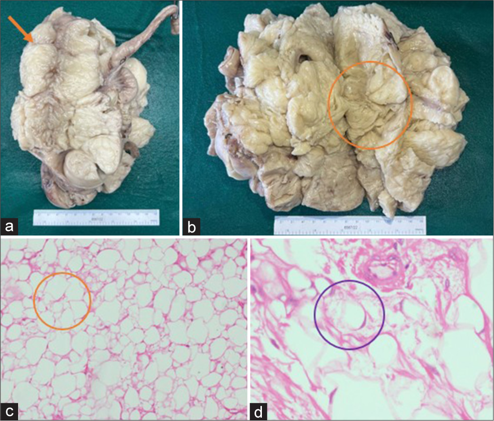 A 1 year old boy with omental lipoblastoma. (a-b) Gross specimen shows a globular, well-encapsulated, soft tissue mass (orange arrow) with a yellow fibrofatty cut surface and no areas of necrosis or hemorrhage (orange circle). (c-d) Histopathology in x200 (c) and x400 (d) magnification shows a multilobulated tumor composed of sheets of predominantly mature adipocytes (orange circle) of varying size with interspersed aggregates of signet ring-like lipoblasts (purple circle).