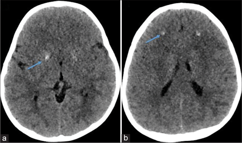 (a and b) Computed tomography of the head (blue arrows) confirmed the presence of symmetric calcification in basal ganglia and frontal subcortical white matter.