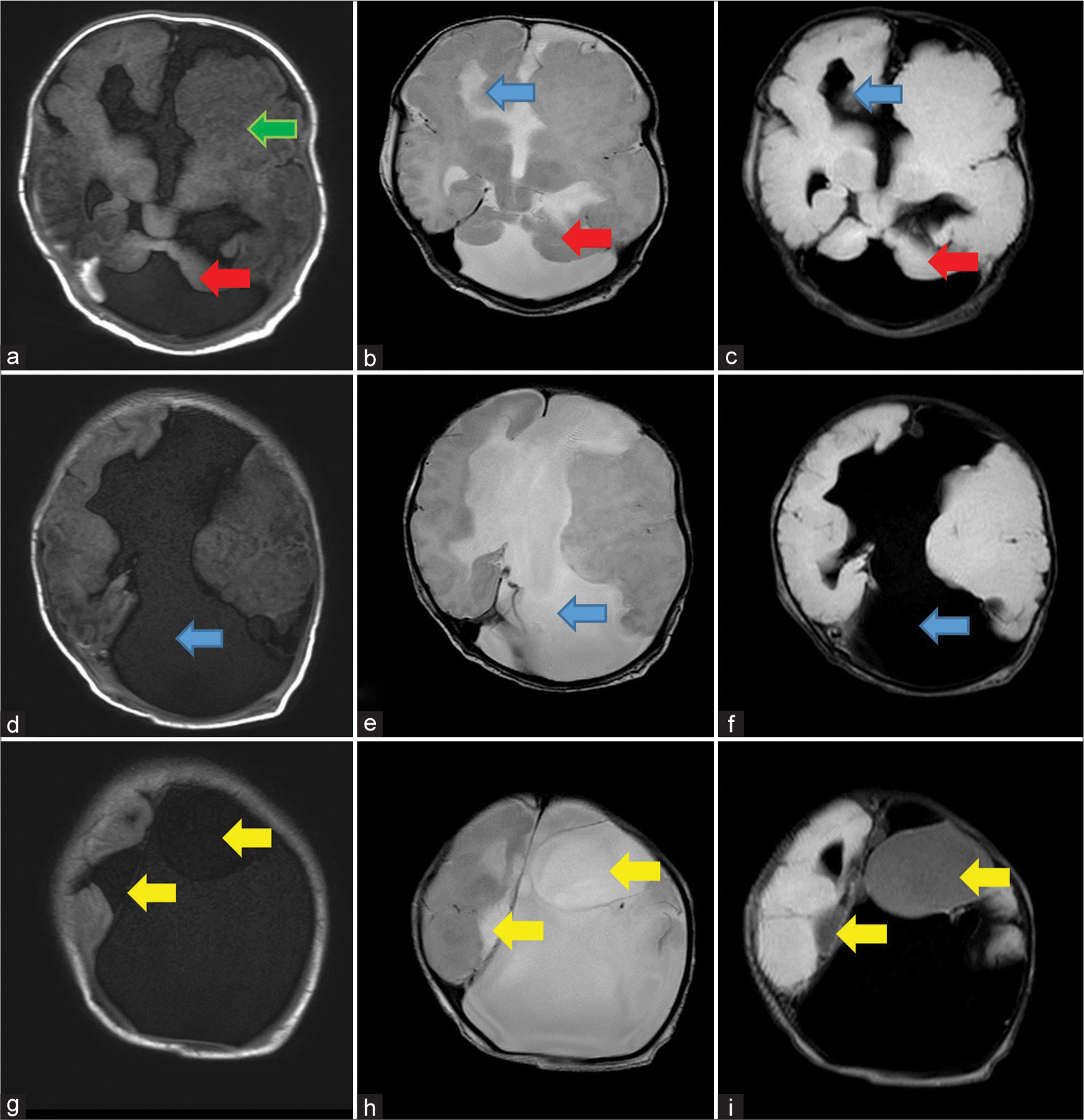 Sequential axial sections of MRI shows: First row: (a) T1 weighted image shows dysmorphic left cerebral hemisphere with polymicrogyria (green arrow), bilateral cerebellar hypoplasia with a large posterior fossa cyst (red arrow), (b), T2 and (c) FLAIR weighted image, shows widely placed right frontal horn of lateral ventricle (blue arrows) and bilateral cerebellar hypoplasia with large posterior fossa cyst (red arrows), Second row: (d) T1 weighted image, (e) T2 weighted image and (f) FLAIR weighted images show non visualization of corpus callosum with large CSF intensity inter-hemispheric cyst (blue arrows), and Third row: (g) T1 weighted image, (h) T2 weighted image and (i) FLAIR weighted images shows few cysts which are not suppressing on FLAIR (yellow arrows).