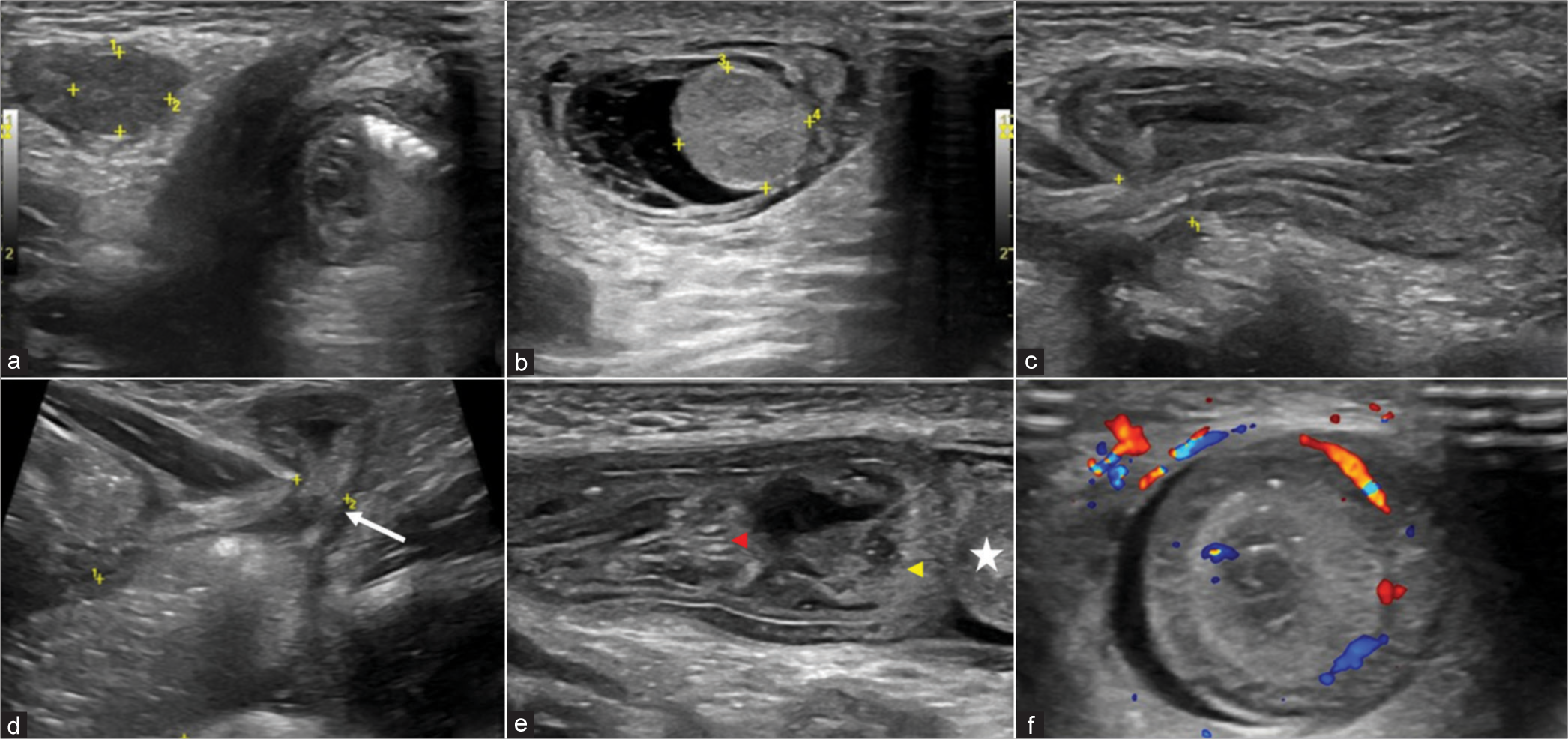 An ultrasonogram of the inguinoscrotal region of a 2-month-old baby boy with left inguinoscrotal swelling using a linear high-frequency transducer shows (a) a normal-sized testis in the right inguinal canal with normal echogenicity, (b) bulky echogenic testis in the left scrotal sac with adjacent mild hydrocele, (c) shows herniating small bowel loop through the enlarged left deep inguinal ring, (d) shows dilated small bowel loops proximal to the neck of the hernia with the transition at the neck (white arrow), (e) shows telescoping of another small bowel loop (red arrowhead) for a length of 1.8 cm into the herniated bowel loop (yellow arrowhead) reaching up to the testis (white star), and (f) transverse section of the herniated bowel loops shows a characteristic bowel within bowel appearance or target sign intussusception.