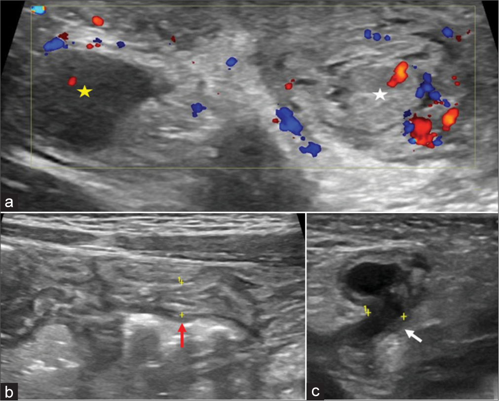 An ultrasonogram of the inguinoscrotal region of a 2-month-old baby boy performed after the reduction of herniated small bowel intussusception using a linear high-frequency transducer shows (a) a normalized testis in the right scrotal sac with normal echogenicity (yellow star) and a hyperechoic testis and epididymis in the left scrotal sac (white star), (b) normal caliber of small bowel loops (red arrow), and (c) persistently enlarged left deep inguinal ring (white arrow) with mild free fluid tracking into the inguinal canal, no bowel loop is seen herniating through the defect.