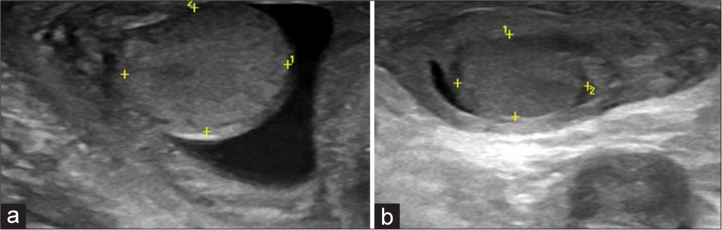 A follow-up ultrasonogram 4 days after the reduction of the left inguinal hernia shows (a) right testis and (b) left testis with normalization of echogenicity of the left testis.