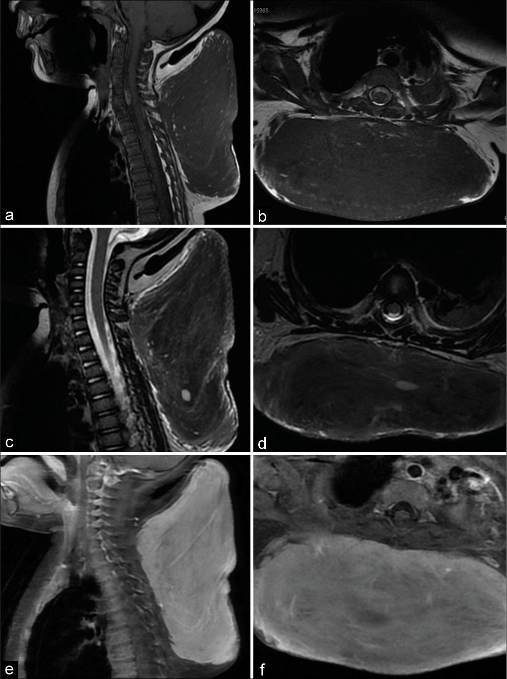 (a) Sagittal T1w, (b) axial T1w, (c) sagittal T2w, (d) axial T2w images showing the diffuse hypointense signal intensity of the lesion on both T1w and T2w images. (e and f) Sagittal and Axial Gadolinium-enhanced T1 Fat saturated (FS) images showing substantial homogeneous enhancement of the lesion.