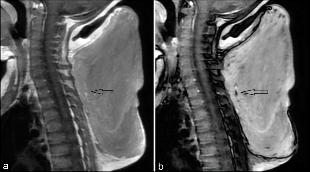 (a) Chemical shift in phase image shows a few scattered hyperintense foci within the lesion (black arrow). (b) Corresponding loss of signal (black arrow) in opposed phase image suggestive of microscopic fat.