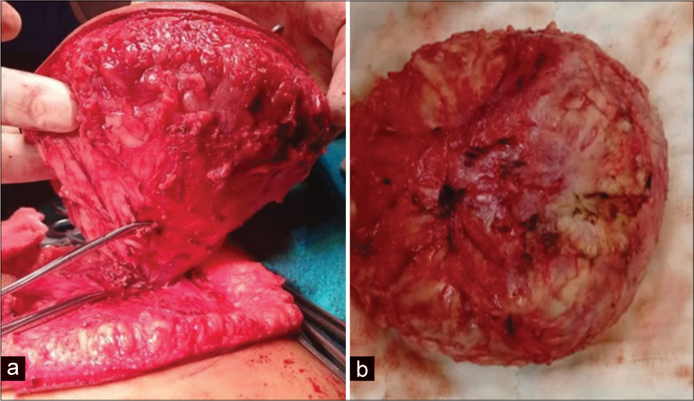 (a) Post-operative excised specimen showing reddish yellow tumor with no capsule. (b) Yellowish fatty component within the excised specimen suggestive of fat.