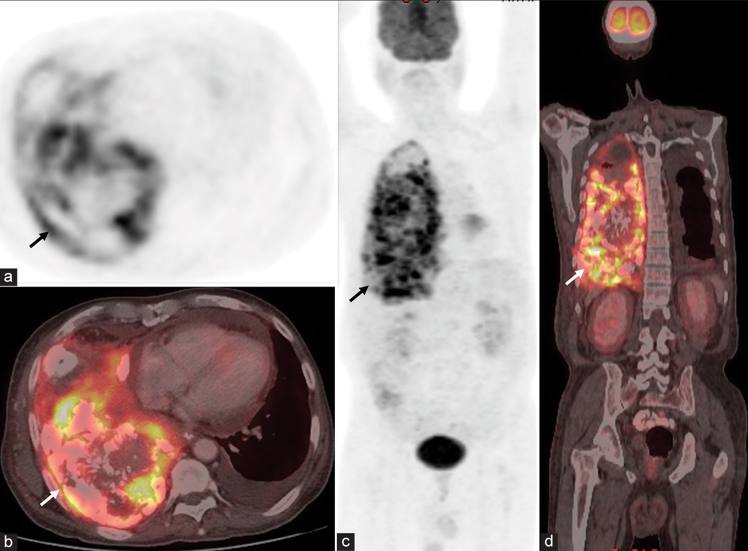 (a-b) Axial chest positron emission tomography (PET) and fusion PET/computed tomography (CT) images show hypermetabolic mass with calcifications/ossifications in right lung (arrows). Left pleural effusion is also seen. (c-d) Whole body PET and fusion PET/CT images show the right lung lesion (arrows). No other malignant lesion is seen.