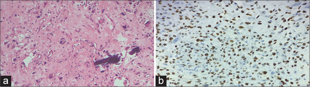 (a) Hematoxylin and eosin stain &40: The tumor cells show densely eosinophilic cytoplasm resembling osteoblasts along with thin, lace-like osteoid suggestive of osteosarcoma. (b) Immunohistochemistry: Special AT-rich sequence-binding protein 2 &100 stain shows nuclear positivity confirming the diagnosis.