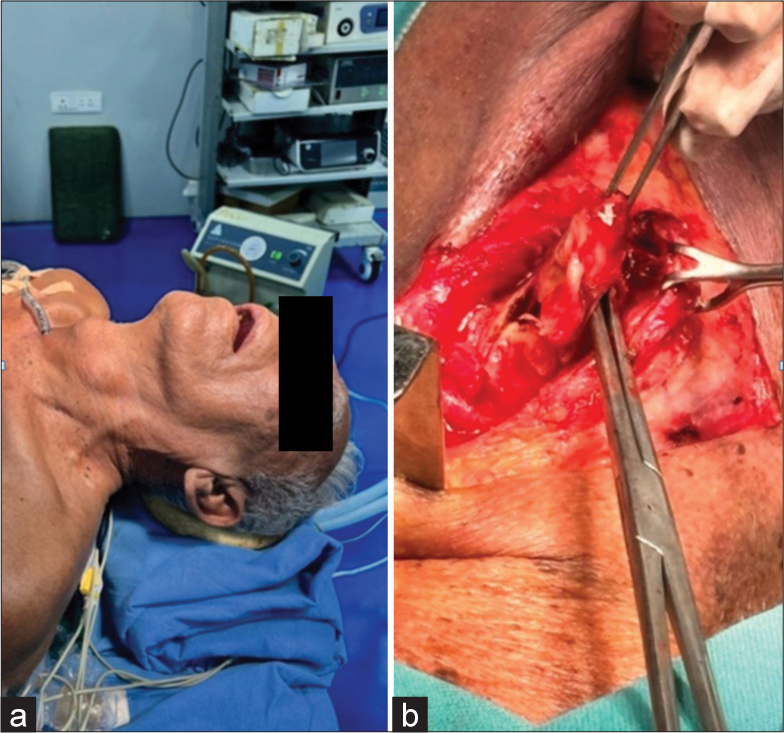 (a) Pre-operative image of the neck swelling. (b) Intraoperative image shows the excised cyst.